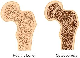 Bone density measurement for osteoporosis